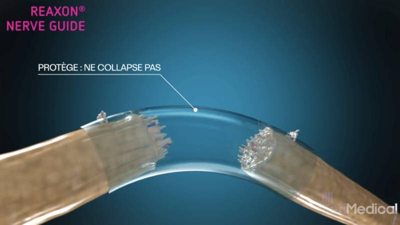 REAXON de KeriMedical — animation 3D pour mettre en avant le mode d'action du dispositif