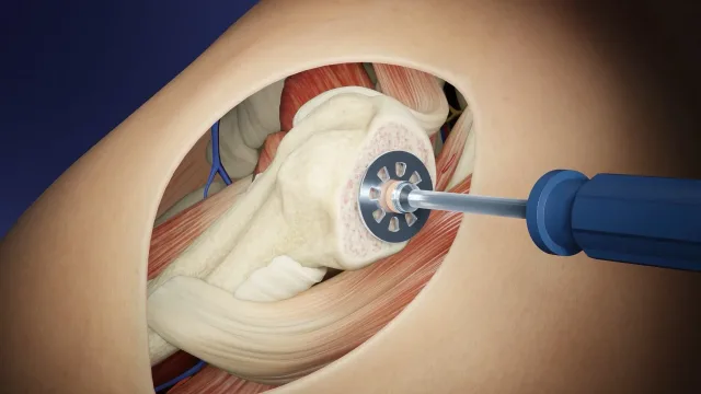 13 films Vidéos 3D — Chirurgie orthopédique