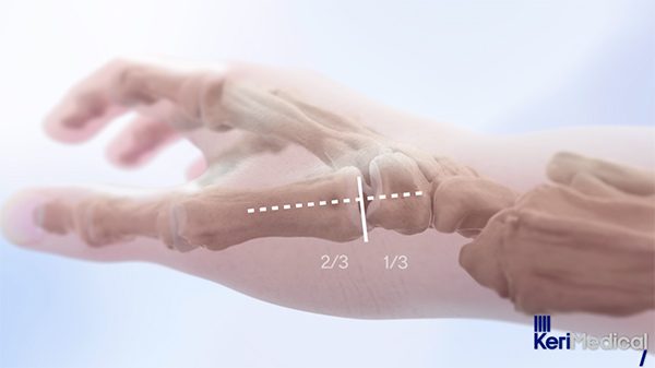 KeriMedical — prothèse trapézo-métacarpienne