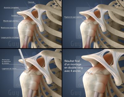 Guy Amsallem - Orthopédie - Reconstruction supra épineux