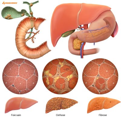 Cirrhose Fibrose du foie Anatomie
