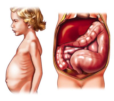 CDROM médical sur la chirurgie Digestive - megacolon